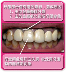 薏安牙醫 全瓷假牙